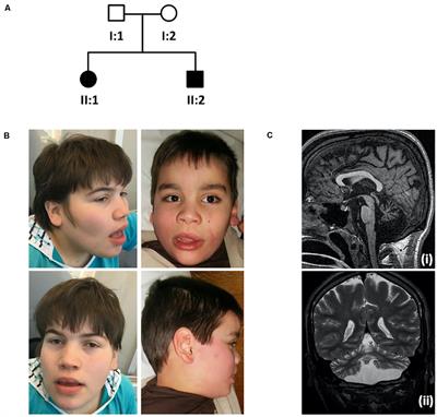 Two Compound Heterozygous Variants in SNX14 Cause Stereotypies and Dystonia in Autosomal Recessive Spinocerebellar Ataxia 20